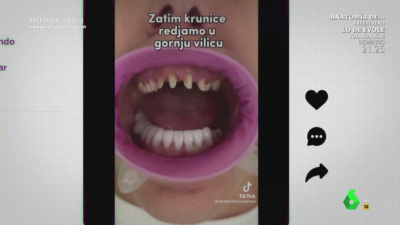 Como odontologo considero que reemplazar los dientes con coronas es